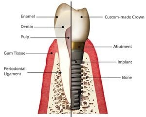 Affordable dental Implants in Plano TX