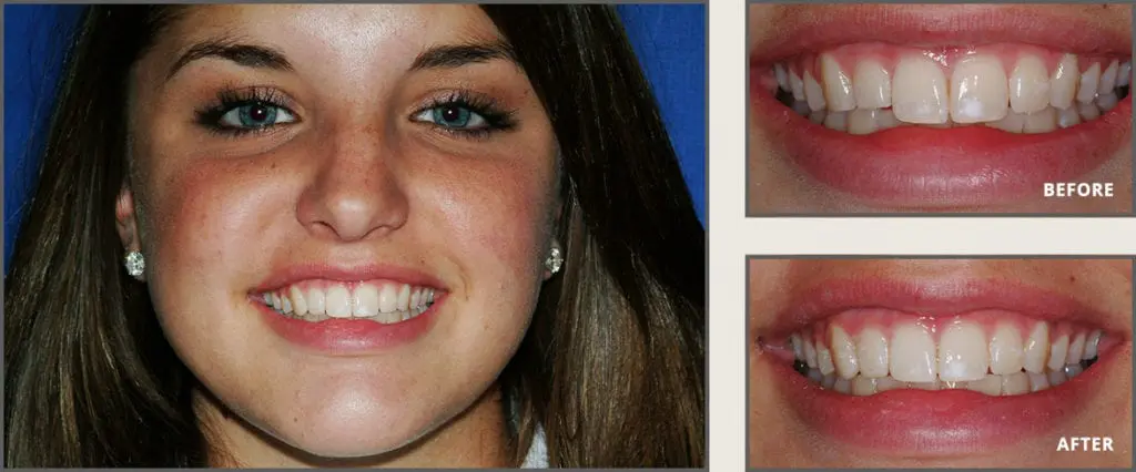 Before and after cosmetic tooth bonding in Plano TX