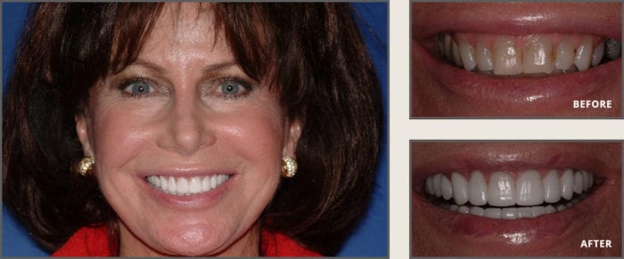 Cosmetic Dentistry before and after in plano, texas