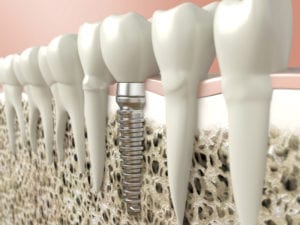 affordable dental implants in Plano Texas