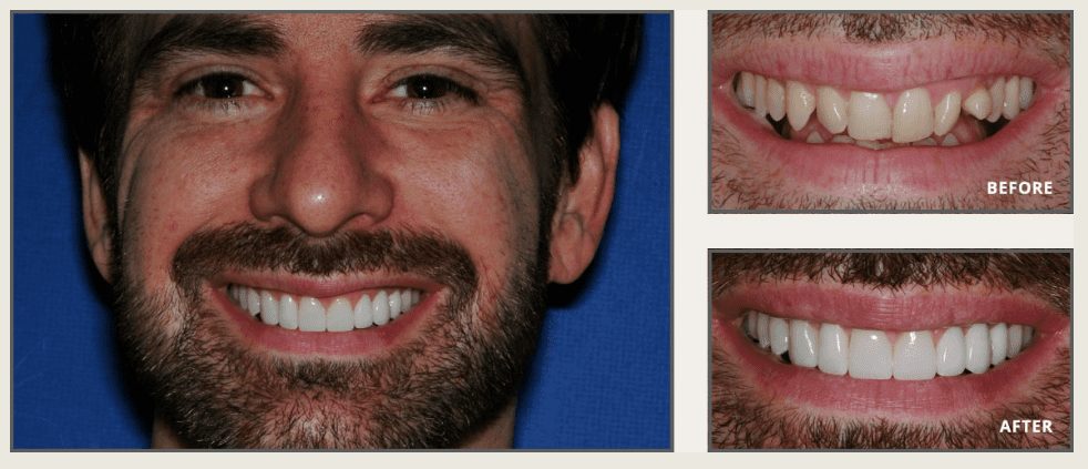 Instant orthodontics in plano, texas