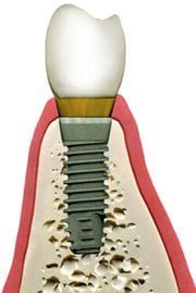 Affordable dental implants in Plano Texas
