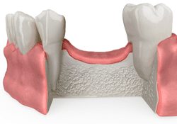 Missing Teeth Bone Loss