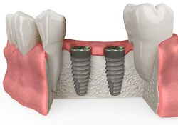Allograft Bone Grafting for Dental Implants