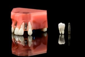 Affordable Dental Implants in Plano Texas by Dr. Mark Sowell