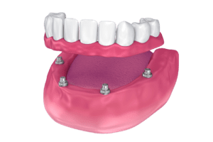 How Can All-on-Four Implants Restore My Smile?