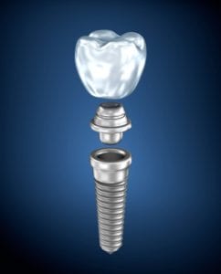 Dental Implants in Plano, TX for lost teeth