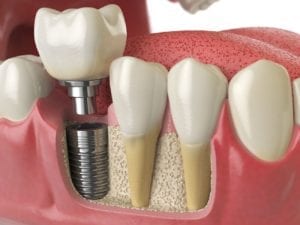 affordable dental implant services in Plano Texas