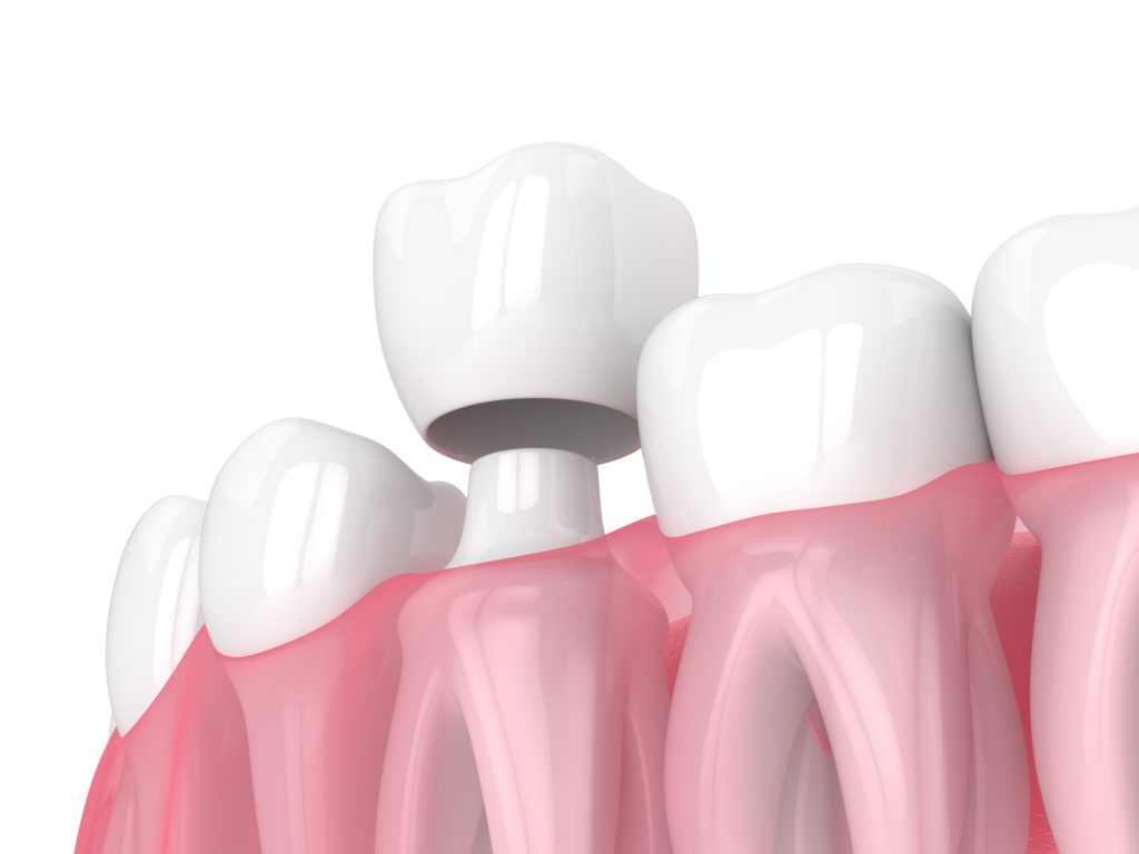 Dental Crowns in Plano, Texas