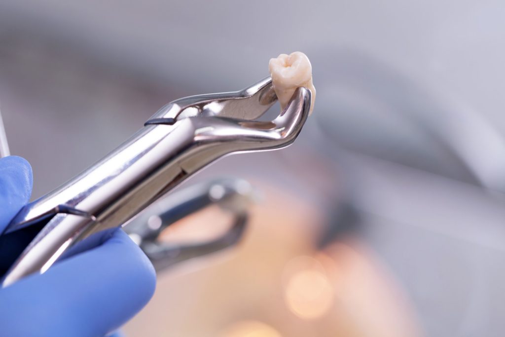 Do You Need a Tooth Extraction?