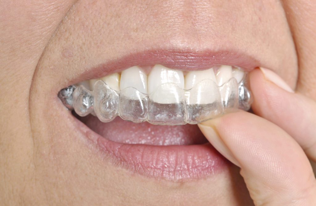 closeup image of woman putting clear aligners in her mouth