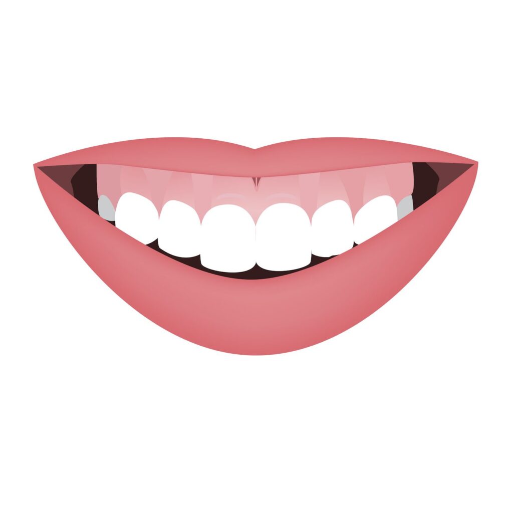2D mouth with a high smile line or gummy smile before treatment