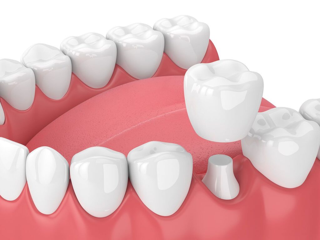 dental crowns in plano, texas
