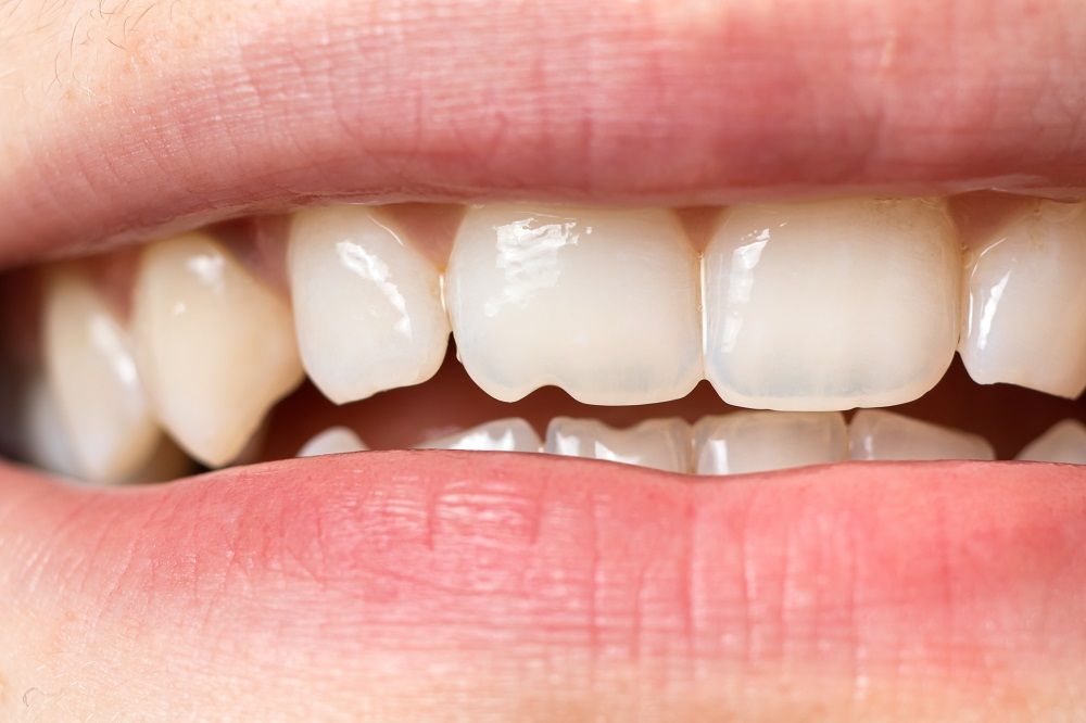 Are Chipped Teeth a Concern?